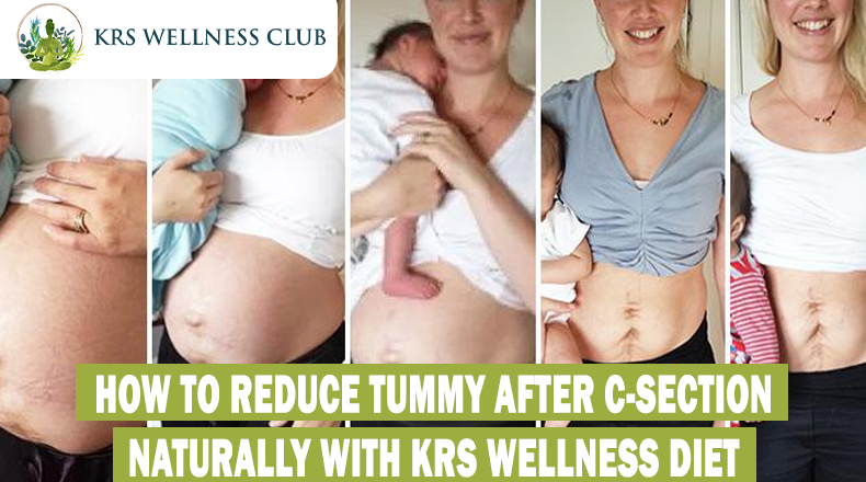 How to reduce tummy after C-section naturally with KRS wellness diet